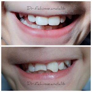 ترمیم شکستگی در اثر ضربه به دندان های دائمی کودکان‎