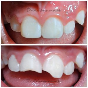 ترمیم شکستگی در اثر ضربه به دندان های دائمی کودکان‎