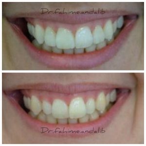 سه واحد لمینیت سرامیکی