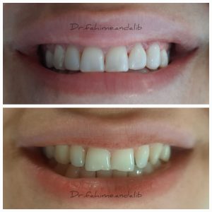 ونیر کامپوزیت