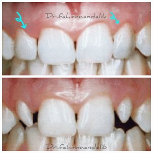 ونیر کامپوزیت