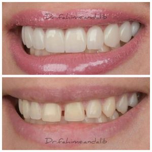 ده واحد لمینیت سرامیکی