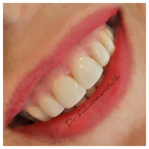 چهار واحد ونیر کامپوزیت